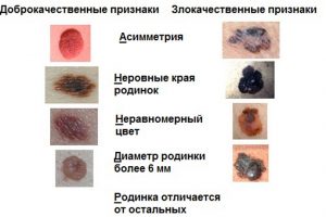 melanoma